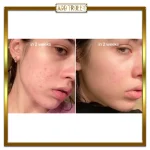 سرم ضد لک آنوا