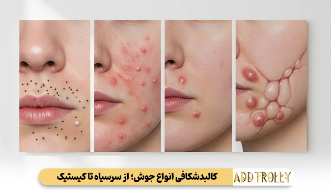 کالبدشکافی انواع جوش؛ از سرسیاه تا کیستیک