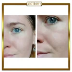 کرم تسکین دهنده آنوا