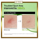 سرم آزلائیک اسید 10% و هیالورون آنوا